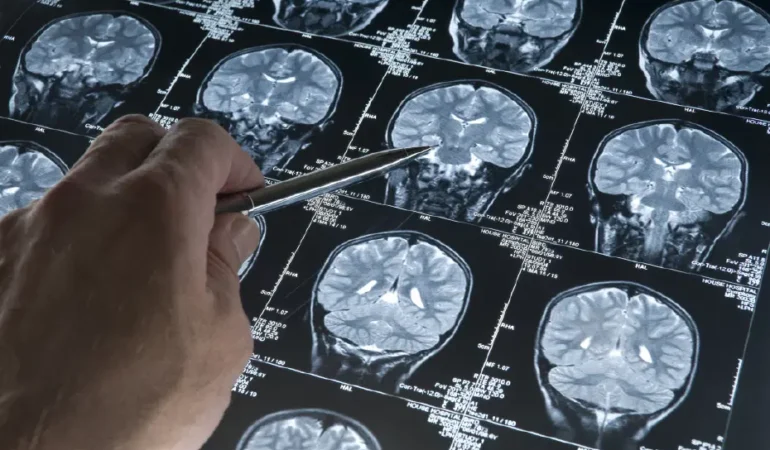 Bilim insanları Alzheimer için TIMP2 proteinini keşfetti